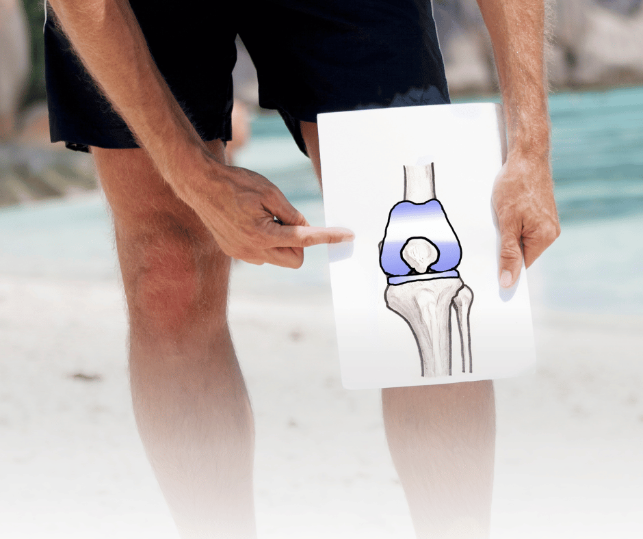 Illustration of a knee joint showing the components of a knee replacement surgery, highlighting the prosthetic components.